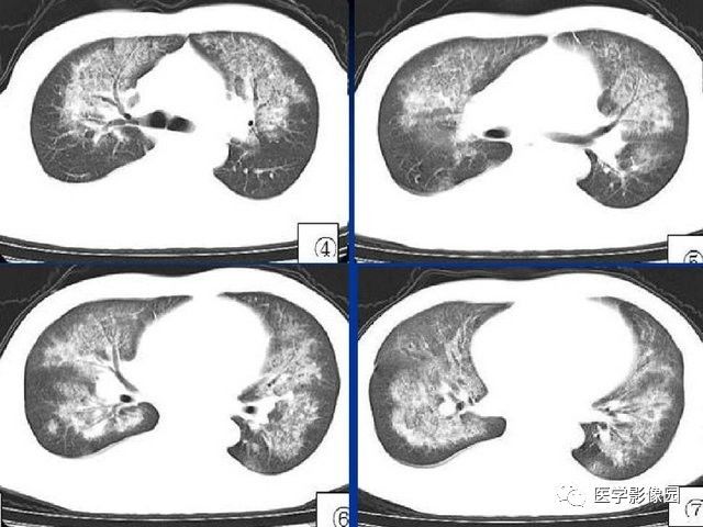 肺水肿的影像学表现图片