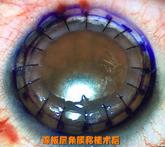 角膜移植后眼睛外观图片