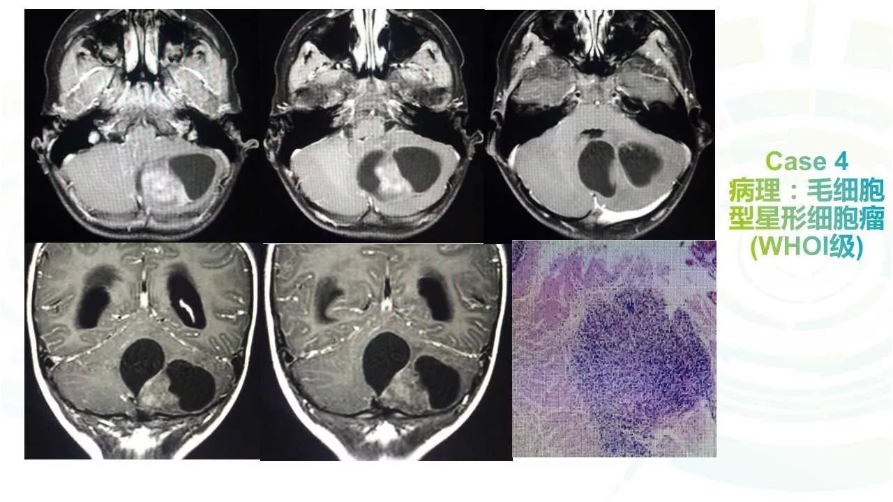 毛细胞型星形细胞瘤的影像诊断全攻略