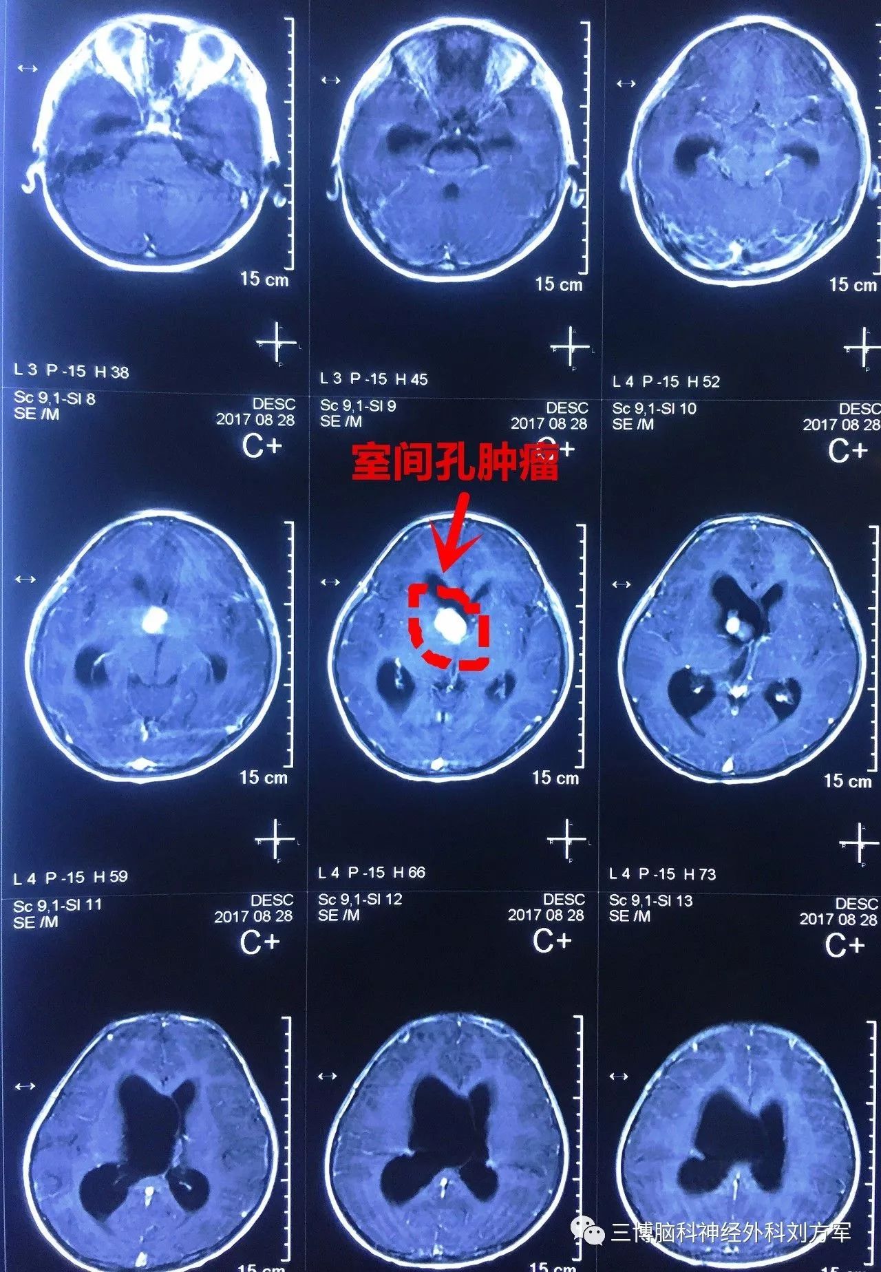 右側單額開顱額葉造瘻室間孔腫瘤切除術