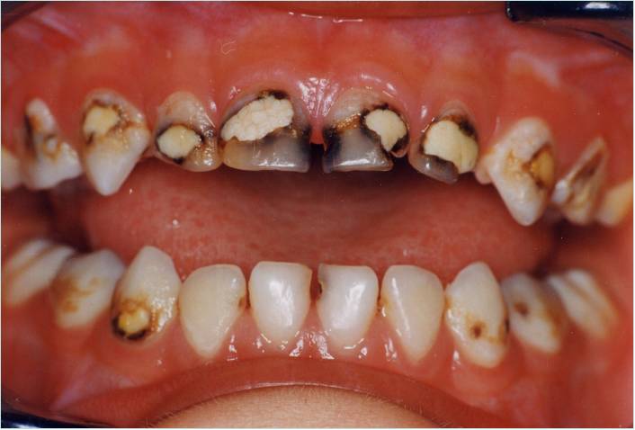 小孩吃糖牙齿长虫图片图片