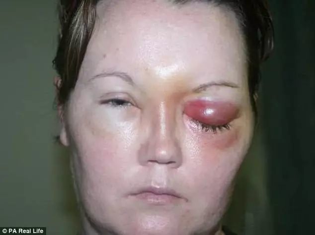 可怕戴隐形眼镜千万注意了澳洲妈妈眼睛长虫头发掉光身体瘫痪被药物和