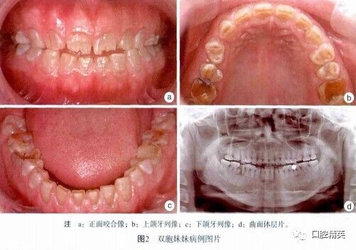 罩牙本质图片