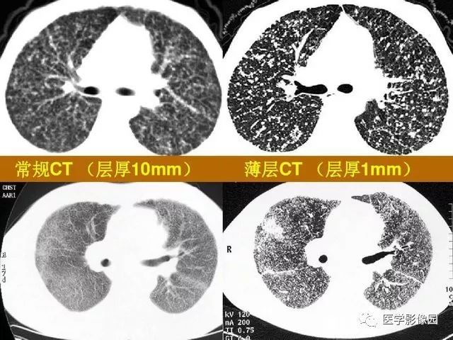 2017年10月01日gxtlc肺间质纤维化的影像学表现r