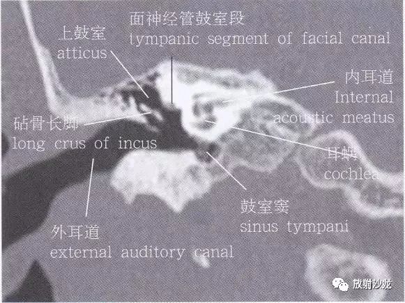 解剖顳骨大體解剖軸位及冠狀位ct斷層圖像