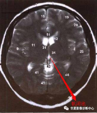第五六脑室形成的ct图图片