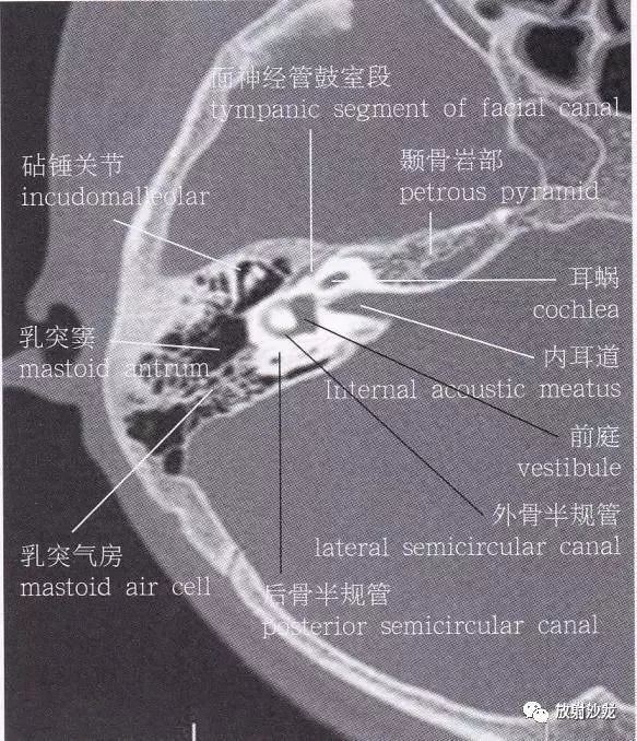 解剖颞骨大体解剖轴位及冠状位ct断层图像