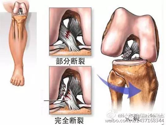 膝關節常見的運動損傷,愛跑步的人一定要注意保養膝蓋!