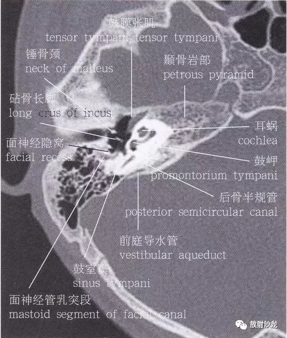 解剖颞骨大体解剖轴位及冠状位ct断层图像