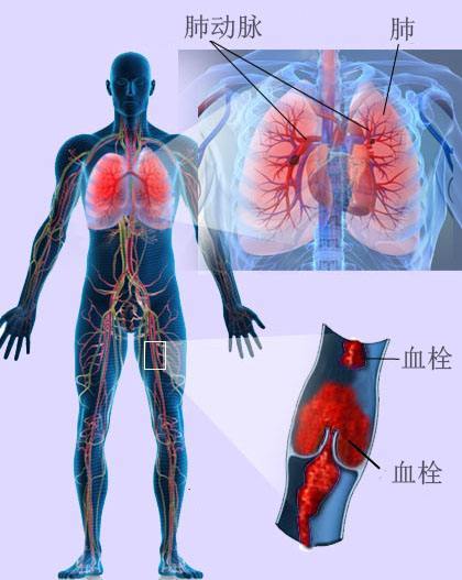 肺栓塞图片 示意图图片