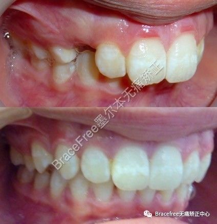 避免了绑固定钢丝的痛苦调整牙弓形状,使恒牙有足够位置自然整齐萌出