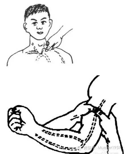 (2)三角巾包扎法:三角巾应用方便,适用于全身各部位的包扎