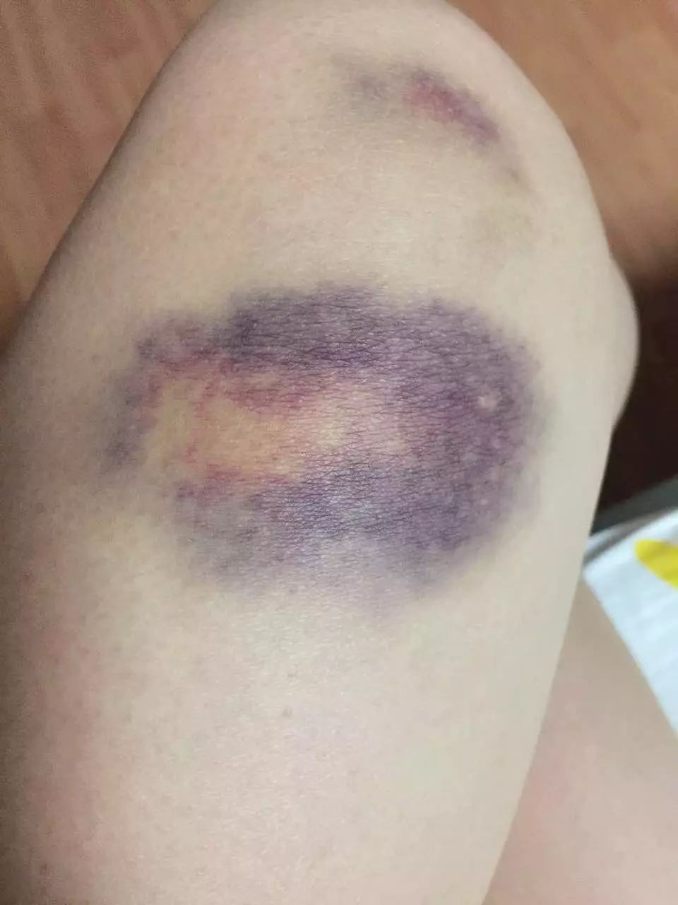 腿碰的淤青发紫图片图片