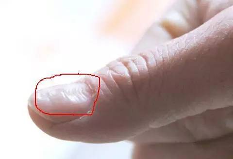 胃癌早期指甲的图片图片