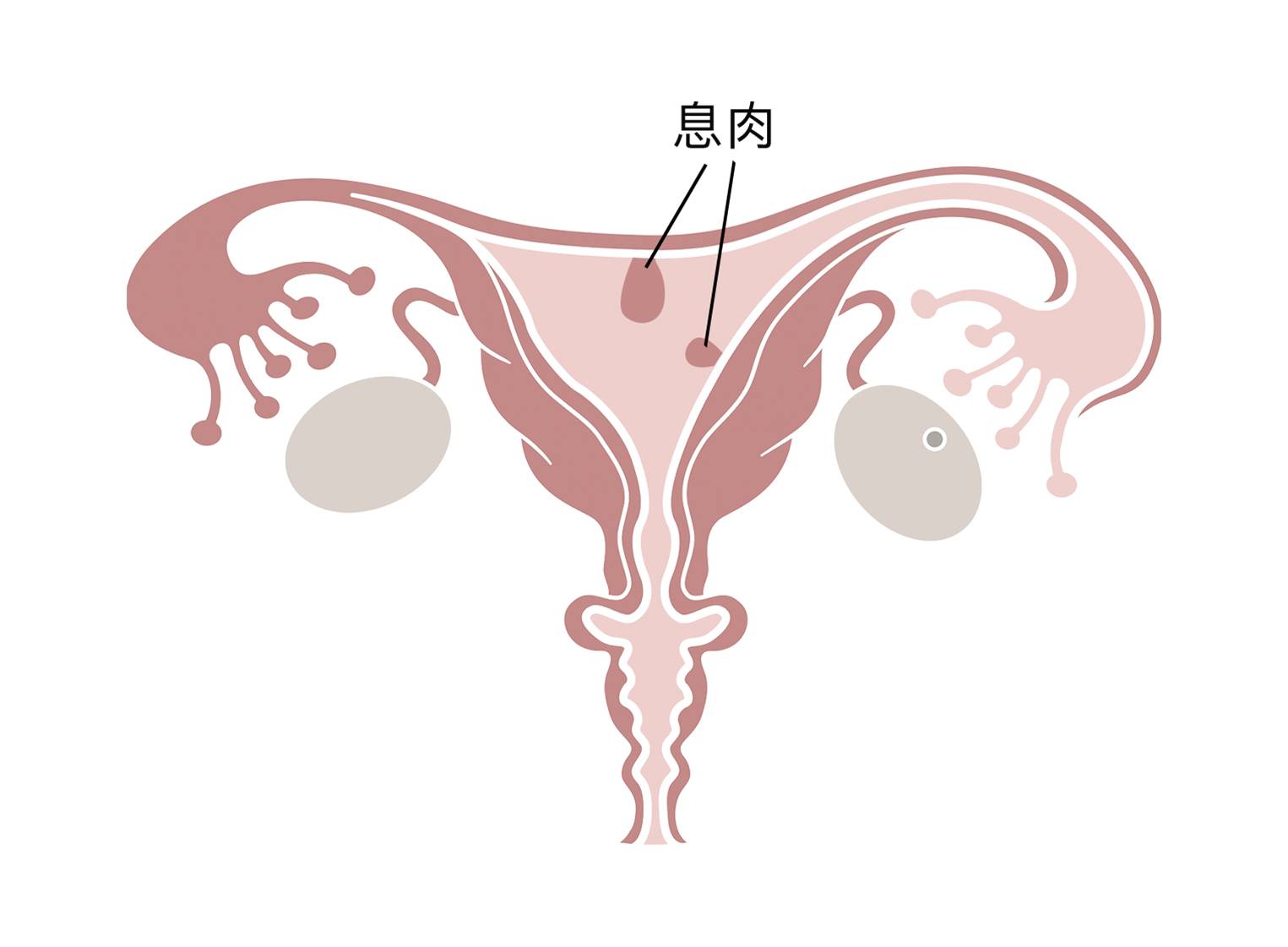 息息相关,不容忽视之浅谈子宫内膜息肉