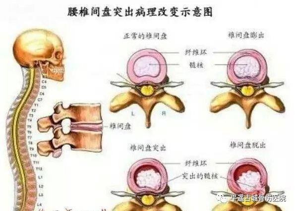 【健康科普】什麼是腰椎間盤突出症