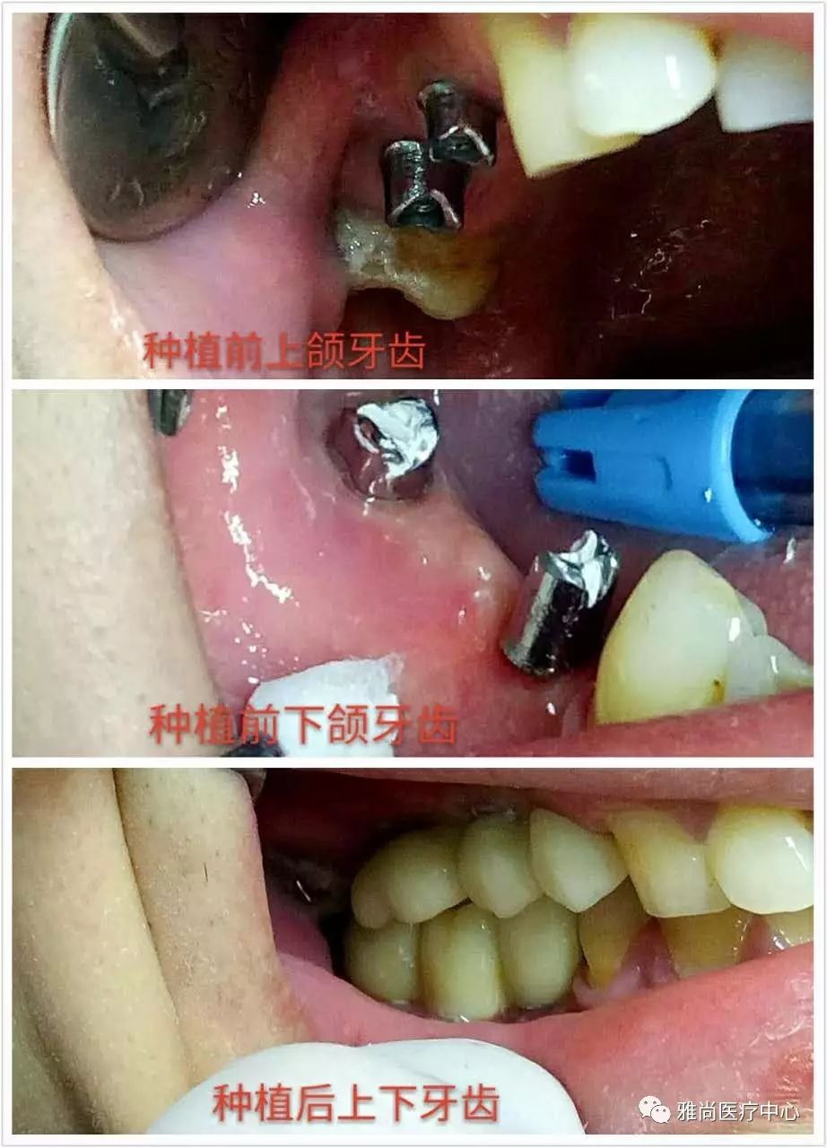 镶牙全过程图片