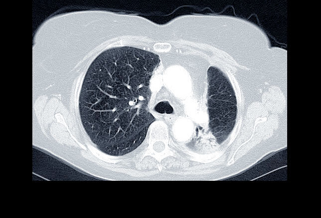 读图诊断肺癌的临床表现你知道吗