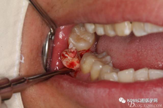 双侧下颌第二磨牙阻生牙的微创拔除
