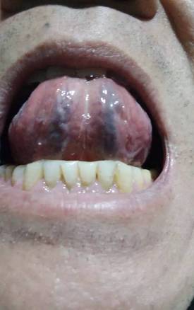 舌下取栓图片位置图片