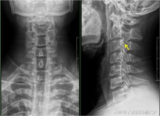 颈椎x光片 突出图片
