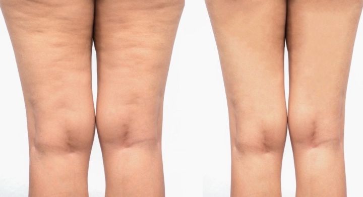 如何缓解几乎每个女生大腿臀部都会有的橘皮组织护肤研究所