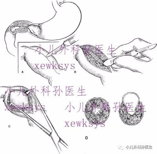 幽门环肌切开术示意图图片