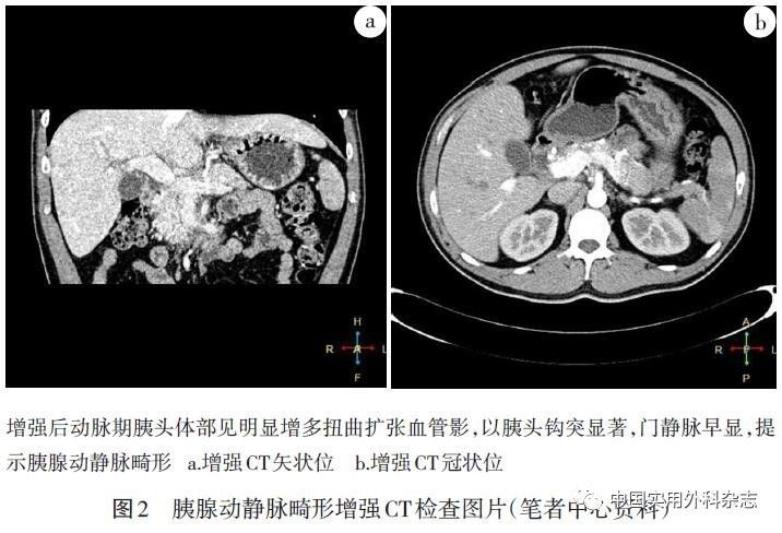 行介入性治疗时,可考虑行dsa检查(图3,其呈现的胰腺avm特征有:脾动脉