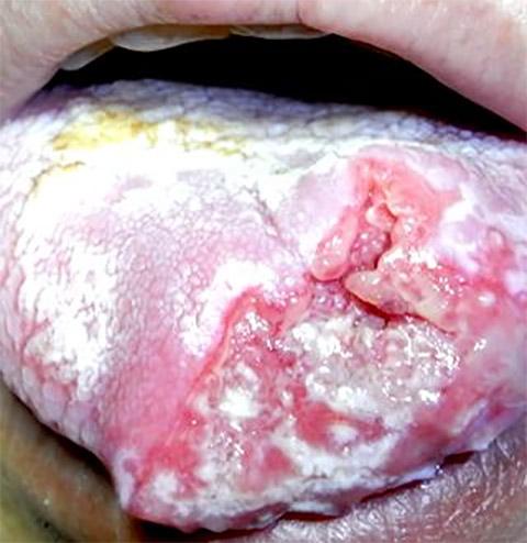 舌癌是口腔颌面部常见的恶性肿瘤,男性多于女性,多数为鳞状细胞癌