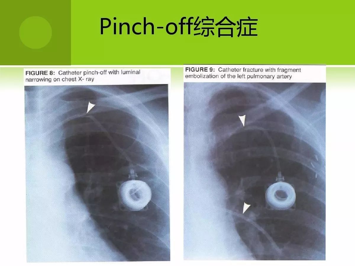 输液港适应症图片