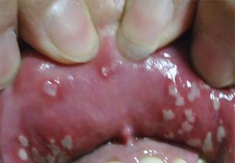 癌 症状 舌