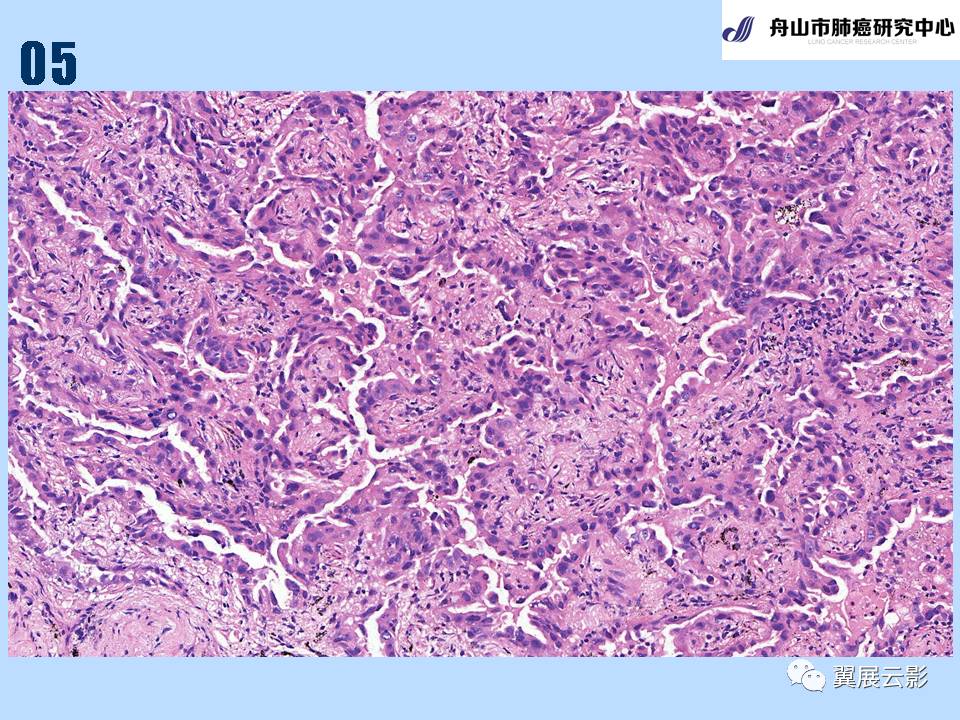 肺癌病理切片图片