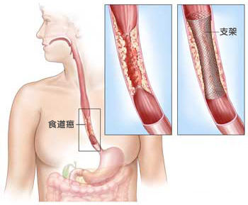 警惕 食道癌会遗传 家有食道癌患者 得病概率高十倍