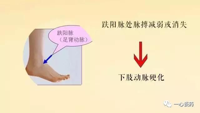 信号5:脚部趺阳脉处脉搏减弱或消失如果我们脚趾的汗毛出现减少的情况