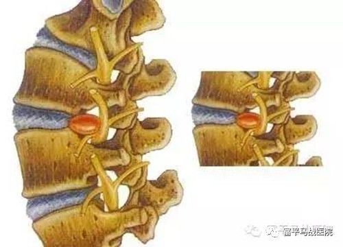 纖維環和後縱韌帶破裂,遊離到椎管,移位椎間盤組織直徑大於基地連續部