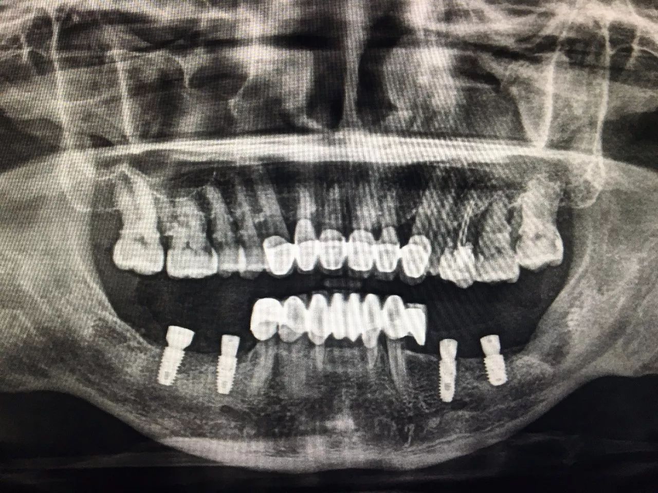 种植牙x片图片