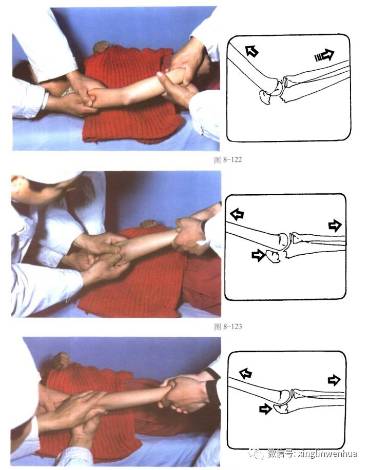 胳膊肘骨折康复训练图图片