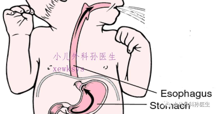 幽门肥厚性狭窄