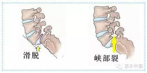 椎弓峡部位置图片
