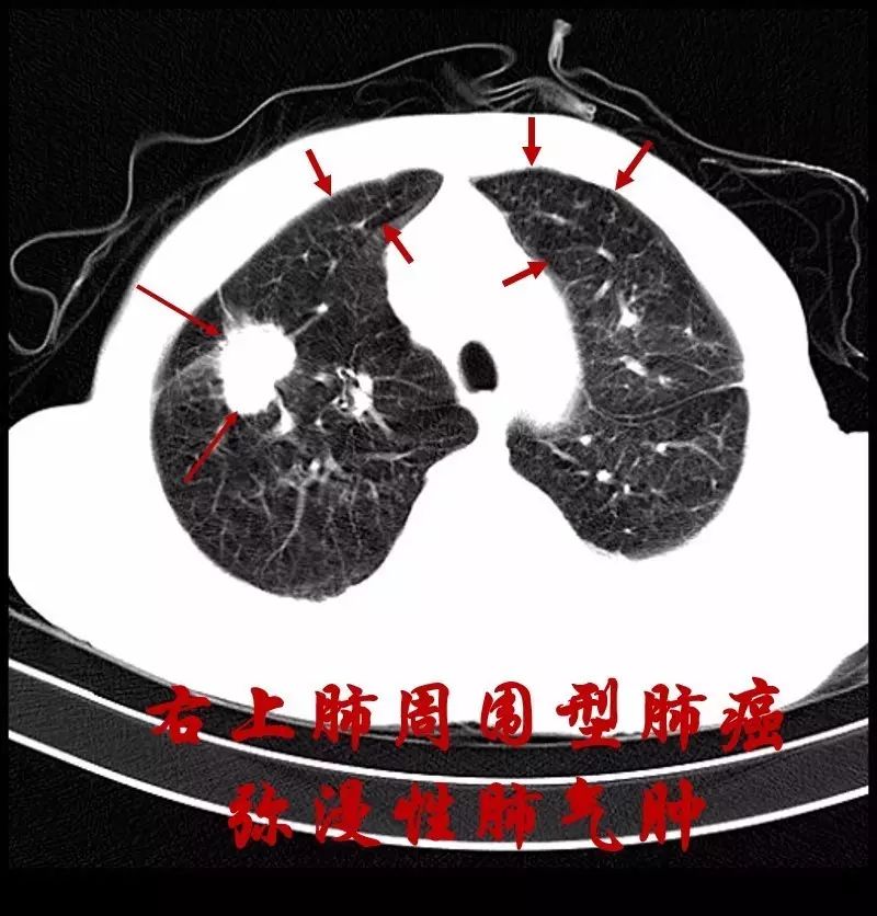 早期肺癌ct图片图解图片