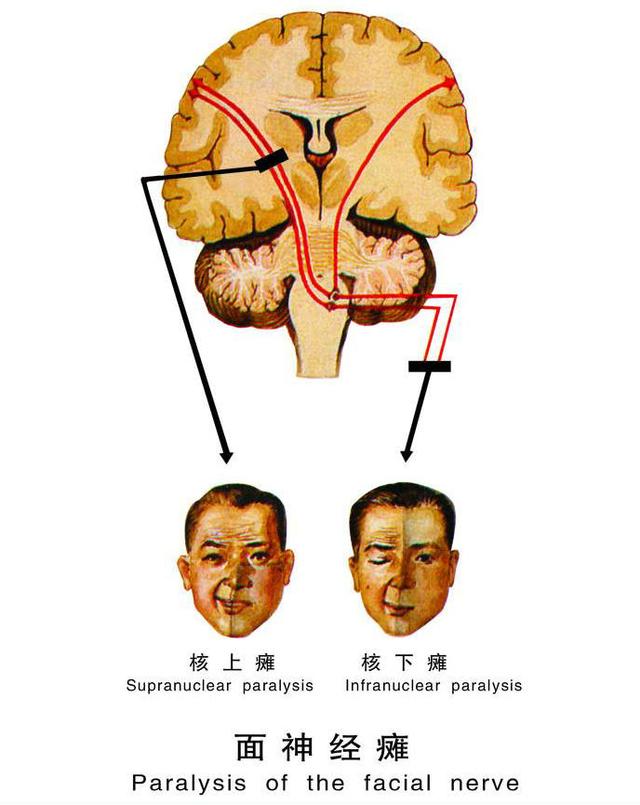 發病原因大多由面部受涼,物理性損傷或病毒入侵所致,面神經的發病之初