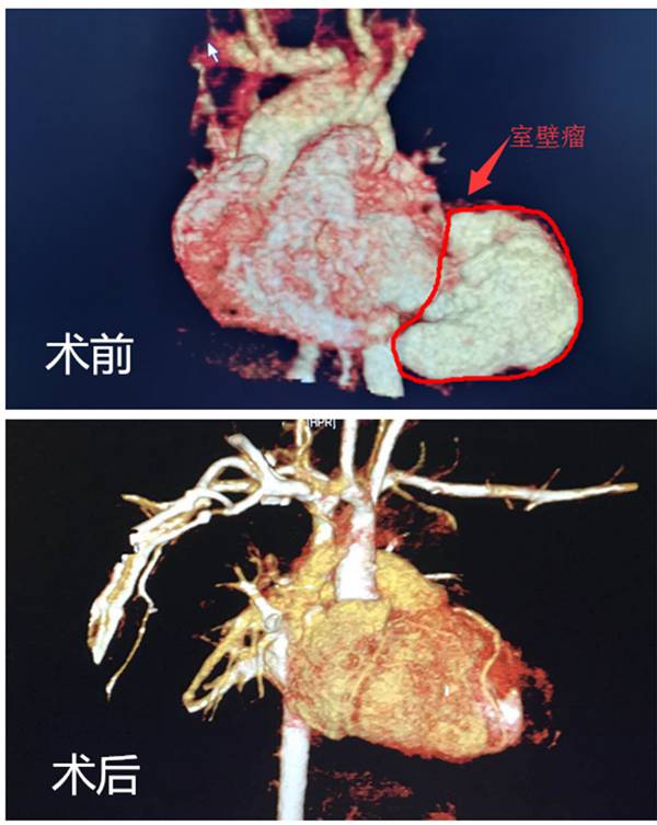 經過心臟超聲及心臟ct造影檢查,醫生髮現孩子的病情非常罕見,在他雞蛋