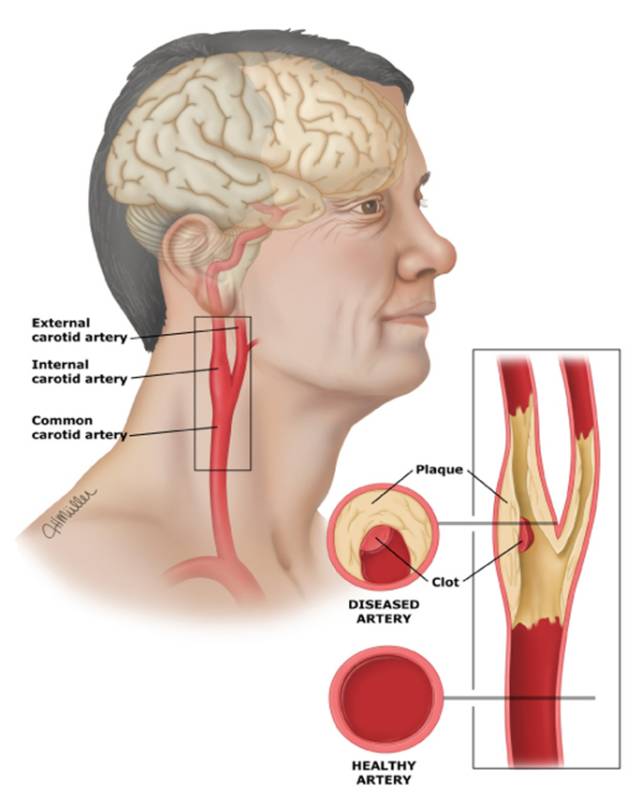 如果動脈粥樣硬化出現在為腦部供血的頸動脈,則可引起頸動脈疾病.