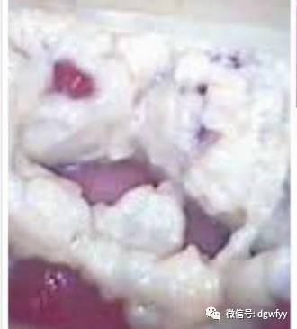 2,豆腐渣样白带:多为霉菌性阴道炎特有,外阴和阴道壁常覆盖一层白膜