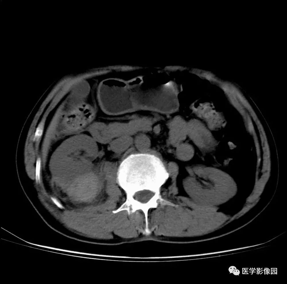 第七章泌尿生殖系统第二节泌尿系统病变四肾脏外伤丨精品连载