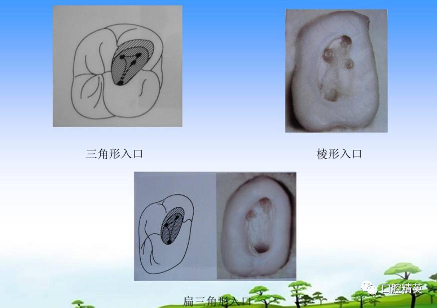 詳解各牙位的開髓整理版