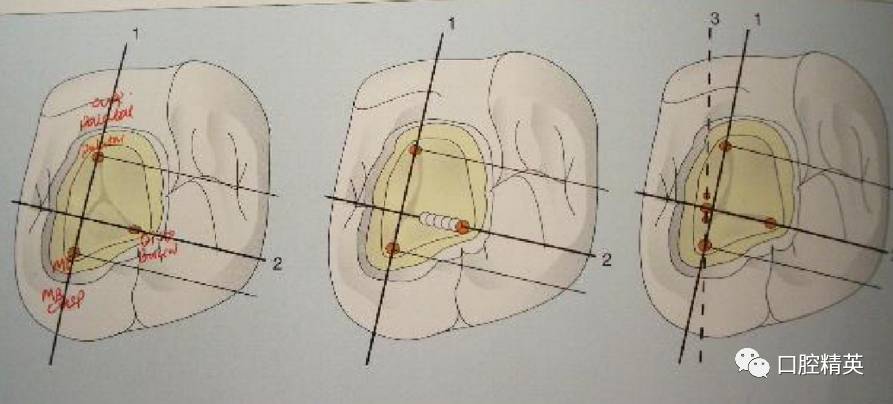 详解各牙位的开髓整理版