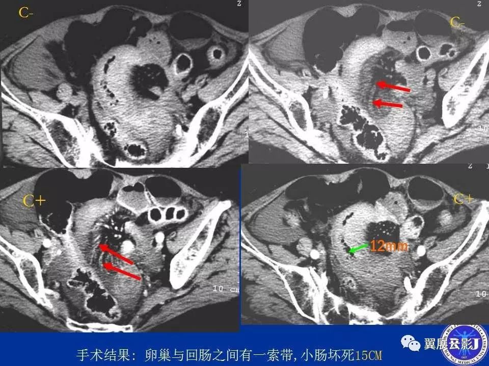 急性绞窄性肠梗阻ct诊断