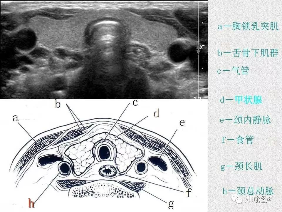 甲状腺超声上下极图图片