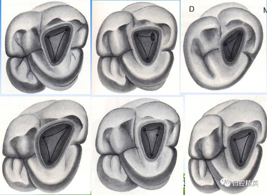 乳牙开髓位置3d图图片